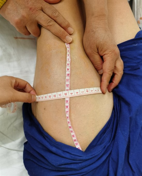 手术切除|老民兵大腿长出六斤重的“哈密瓜”这是种多发于四肢的恶性肿瘤