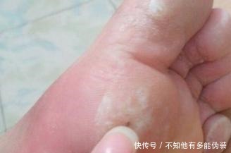 征兆|脚上出现这5种症状, 是大病征兆, 再不注意就晚了!