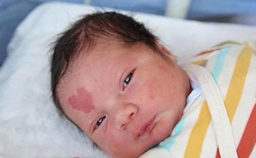 化学物质|胎记是怎么来的?产科大夫:除了遗传,孕期的这3种行为尽量避开