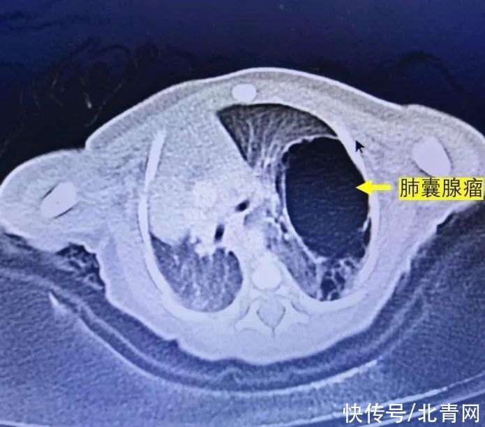 多学科|贵州首例！出生4天的新生儿做这个手术