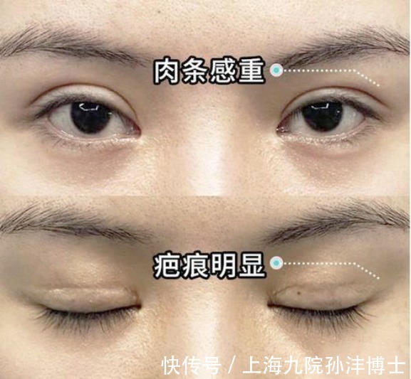 眉眼|上海九院孙沣博士:如何拥有自然好看的双眼皮?