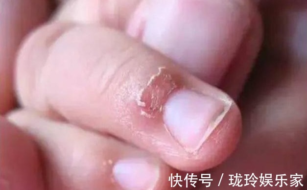 营养物质|孩子手上经常出现“倒刺”,家长着急,可能是3个原因引起的