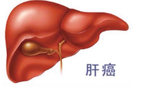 肝癌早期|肝癌早期不止肝疼，3种症状，及时发现，才不会延误治疗！