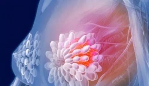 形态|钙化是癌变的信号和哪些癌症息息相关呢