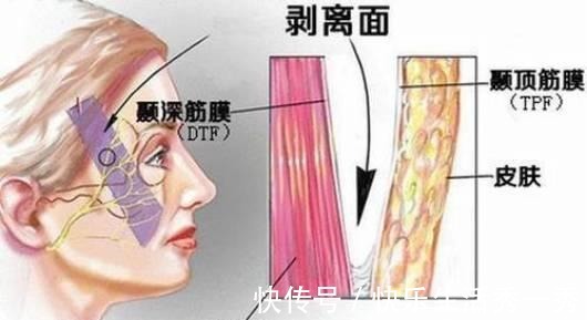 拉皮手术 王小民教授小拉皮手术切口在哪里,会留疤吗!