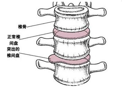 腰椎|民间郎中土方子:3根大葱+1勺红糖,腰不疼了,坐骨神经痛也好了