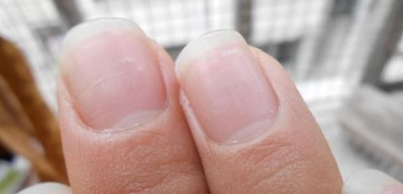 慢性炎症性皮肤病|身体生病,指甲先知?指甲若有5种表现,或许是疾病的“信号”!