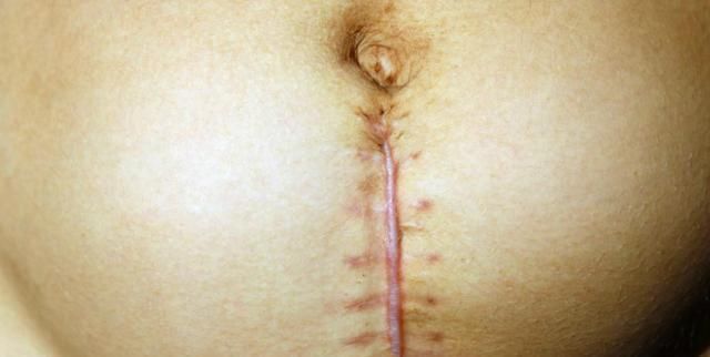 美容线|剖腹产时,伤口缝线处理是用美容线好还是拆线的好?