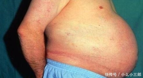 他因便秘离世,身体状况令众人震惊,并成为博