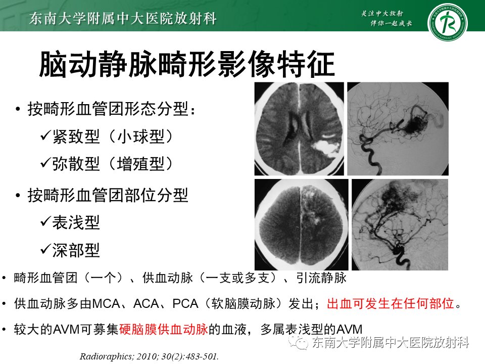 影像学|脑动静脉畸形影像学特征