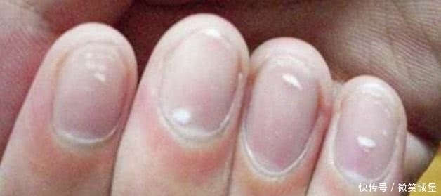 搞错|指甲上的“月牙”越多越健康吗多数人搞错了,不妨看看