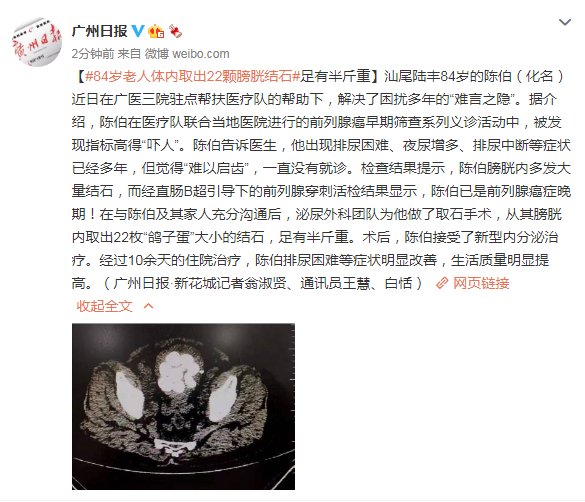 泌尿外科|84岁老人体内取出22颗膀胱结石，足有半斤重