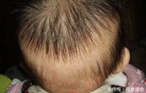 补钙|宝宝枕秃不要盲目补钙,首先你得搞清楚是生理性的还是病理性的?