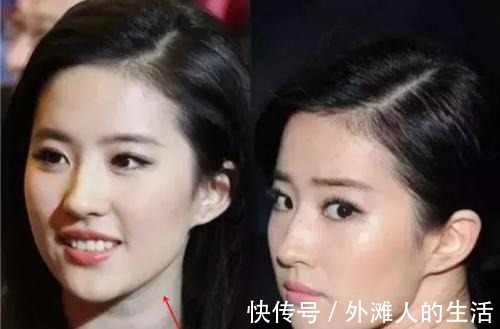 微针 祛颈纹,还是医美最可靠!