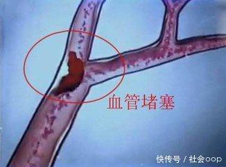 肺栓塞|体内有没有血栓,看看你的手和脚就知道