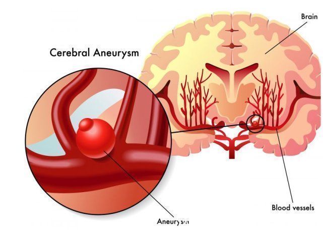 大叔|50岁大叔高血压不吃药,引发脑出血,医生:超过这个值必出问题
