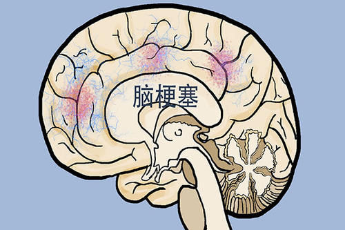 中风不是说得就得的，59岁阿姨，及时发现身体异常，救了自己一命