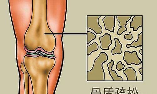 50岁后经常跑步,是养生还是会加速膝盖衰老?听听医生怎么说
