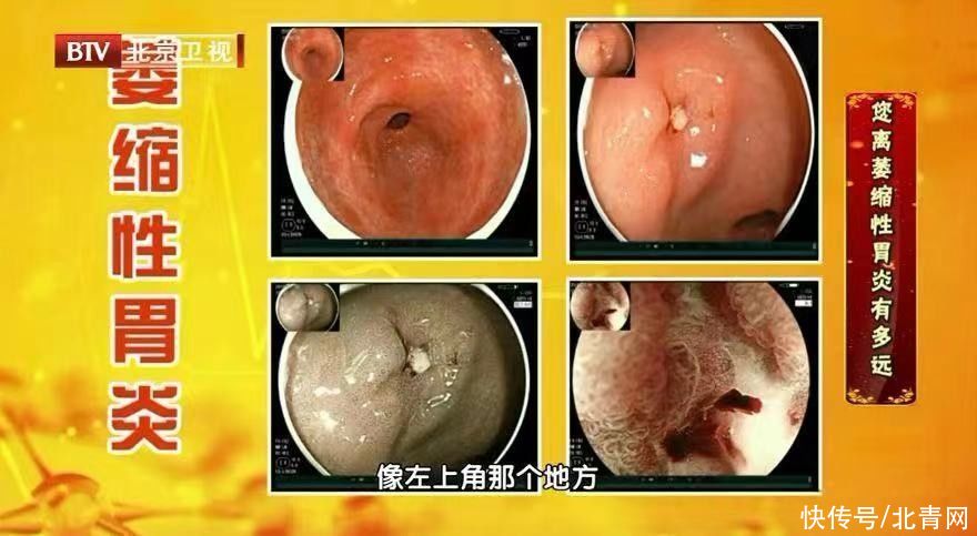 胃食管反流|胃病无小事，一不小心可能拖成癌！有这些迹象要及时就诊