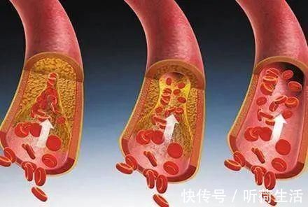 脂蛋白颗粒|血脂报告中除了“坏”胆固醇,还应该关注什么?