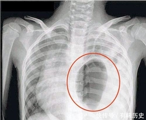 食管裂孔疝|爸妈要好好照顾婴儿,不然有各种问题出现,看到最后一张图明白了