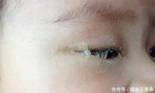 孩子|5岁宝宝眼睛“看不见了”,家人以为没睡好,检查后医生来晚了