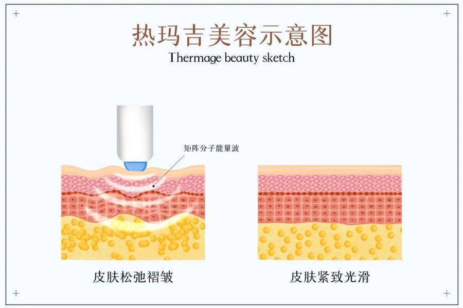 胶原蛋白 怎么让自己做的一次上万元的热玛吉不白做呢？