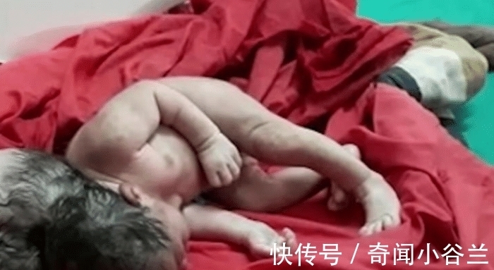 脑肿胀|外国妇女生下三个女孩!没有感觉的时候怀孕了,产科医生:像外星