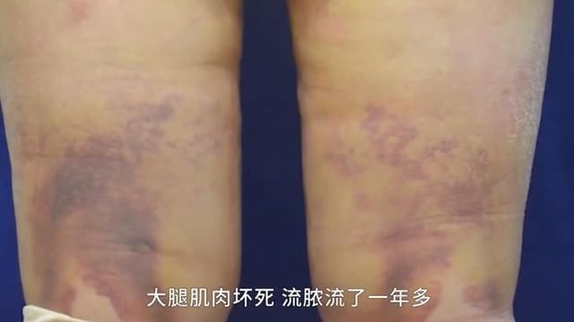 女子整容花费6万元,脸上天天挂着注射器,医院赔你13000