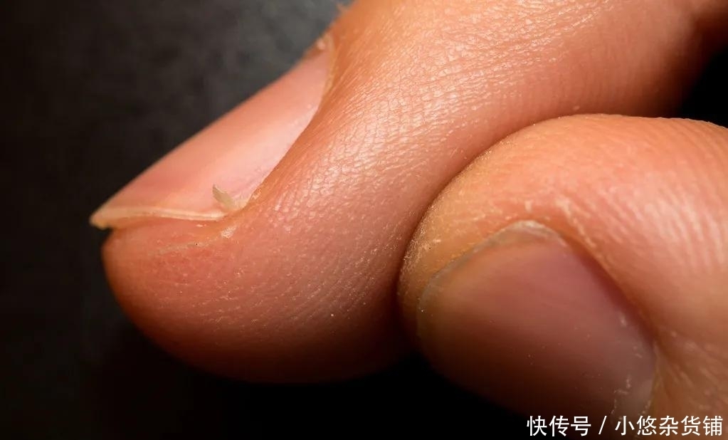 从表皮伤口到骨髓发炎,「拔倒刺」带来的伤害有多“深”?