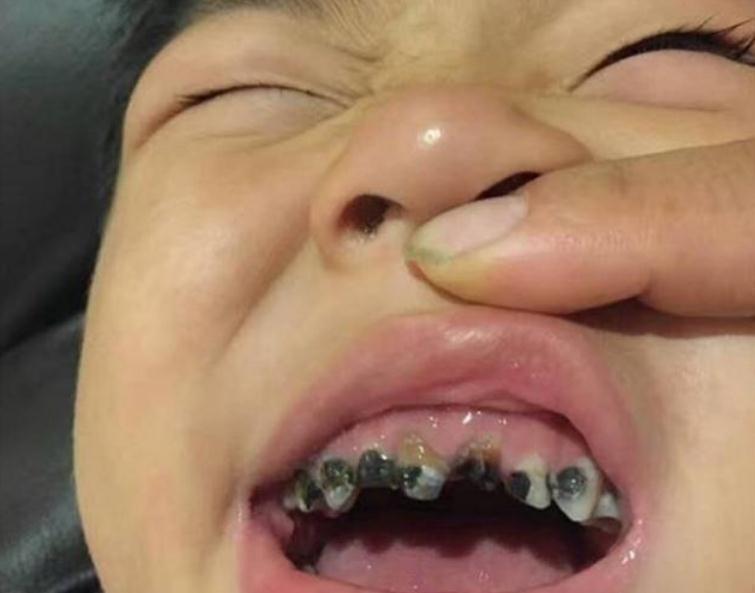 牙齿|让娃满口“小黑牙”的始作俑者并非糖,而是这东西,多数父母不知