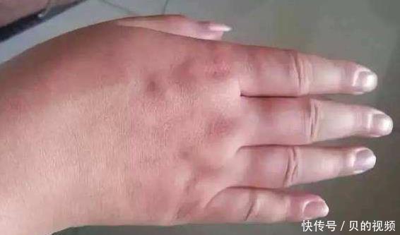 肝脏好不好,都“写”在手上了,手上若无3种“异常”,肝还不错