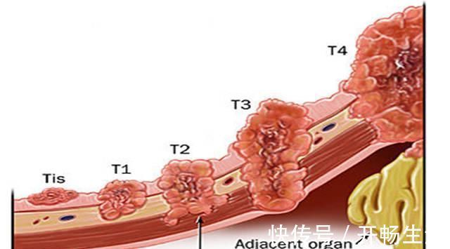 分期|“胃癌从早期到晚期”大概需要经历多长时间
