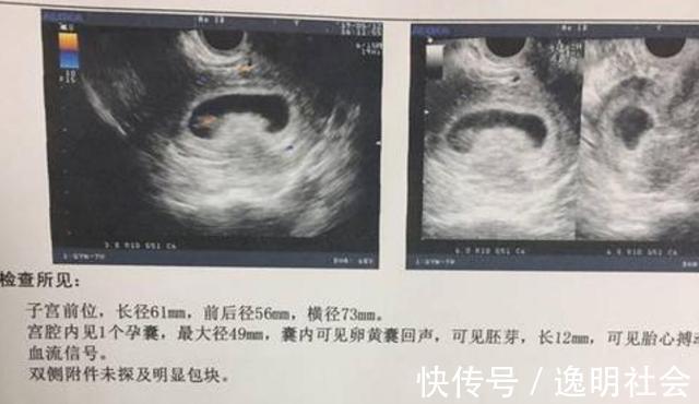 检查|怀孕后总是小心翼翼闯过了这6关孕检,孕妈就可以松口气了