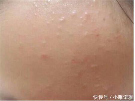 脸上都是小米粒痘痘怎么办唯诺雅教你快速简单的方法
