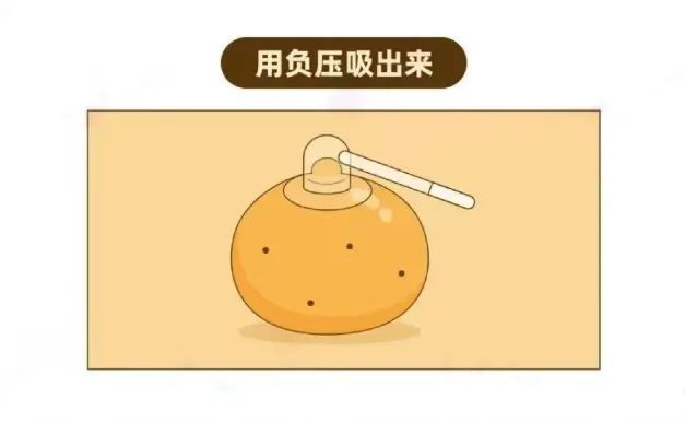 乳腺癌|乳头凹进去了怎么办？会是乳腺癌吗？干货！