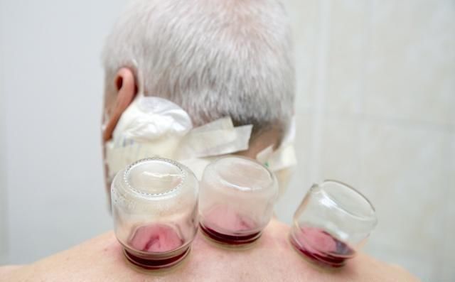 拔火罐可以排毒嗎？至少它這6大功效，還是名副其實(shí)的