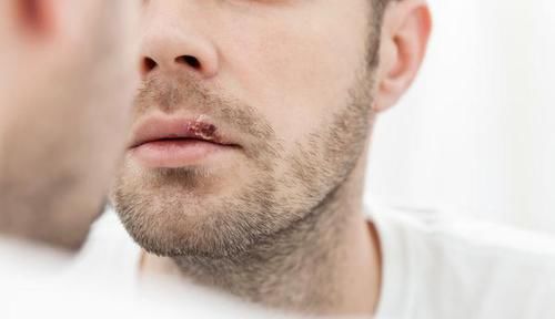 嘴唇干燥起皮,或是这5个原因,很多人都没注意!