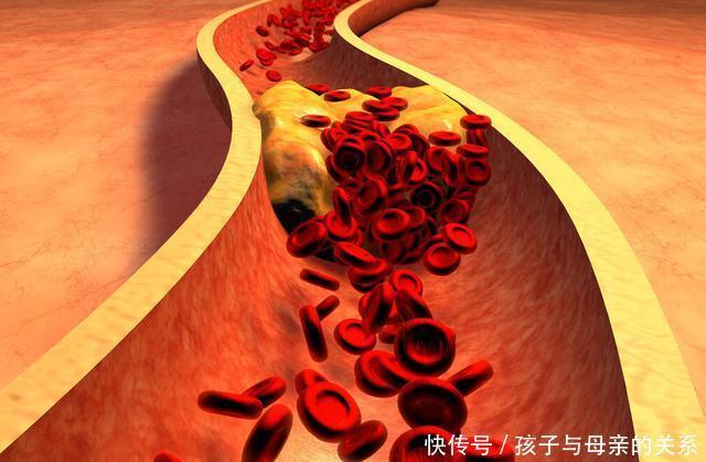 中国|中国脑梗发病率高?医生忠告:与肥肉无关,厨房这一调料是祸首