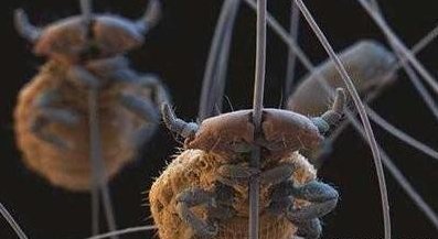 为何30年前农村几乎男女都有虱子，现在怎么没了虱子是哪来的