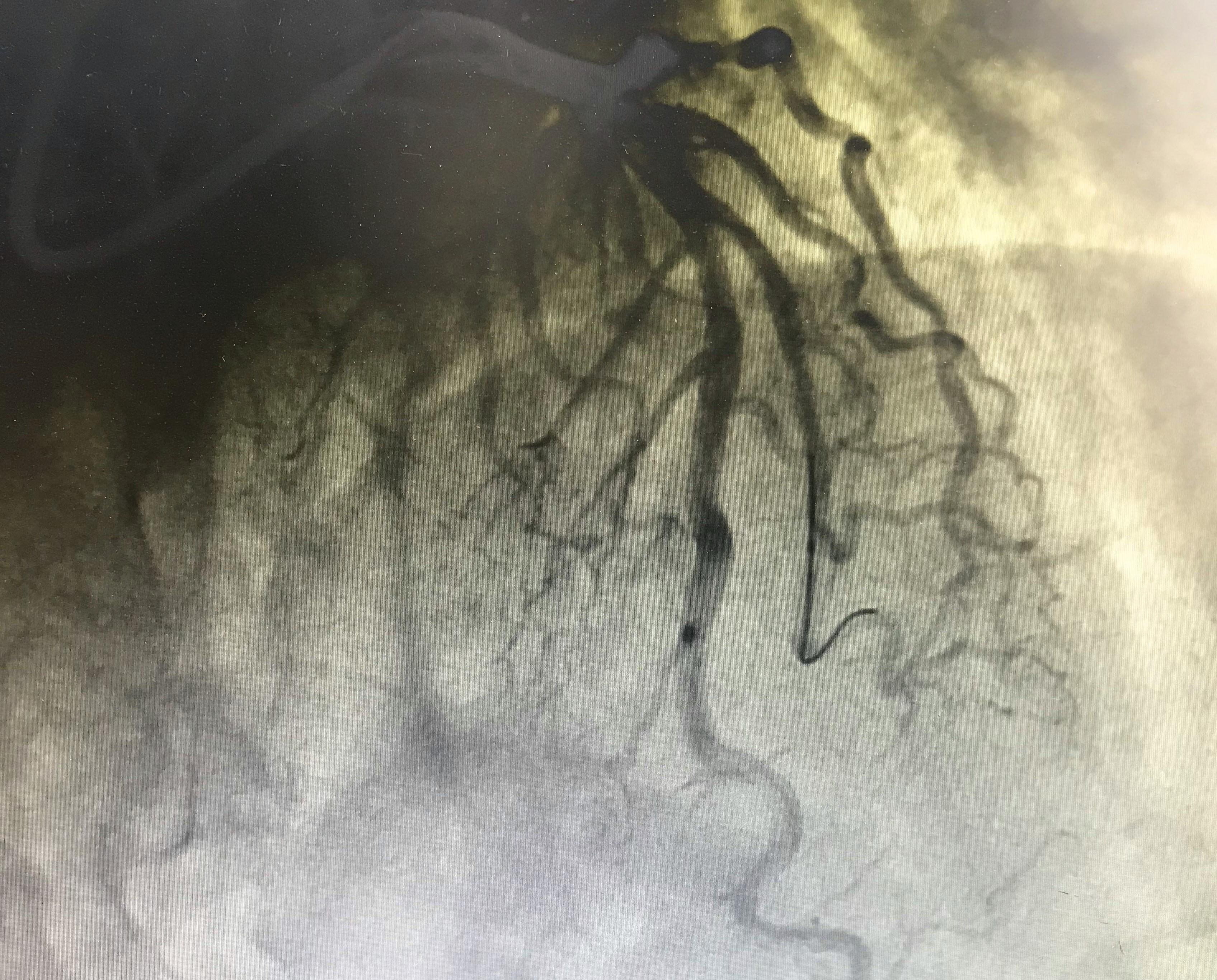 77岁老人反复心绞痛，吃饭的时候都发作，支架治疗后，结果怎样了