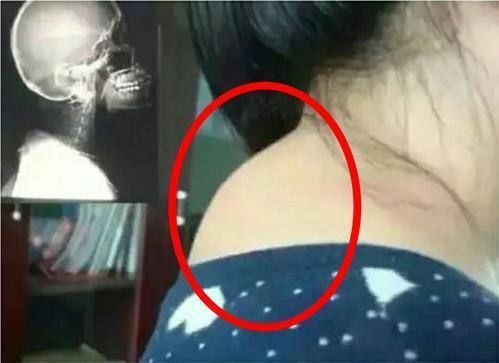 筋膜|颈椎病、富贵包、头痛手麻,都因为这个姿势!如何预防?