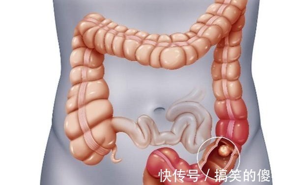 腹痛|肠癌一查多数晚期医生日常身体有“2痛3多”,最好去查一下