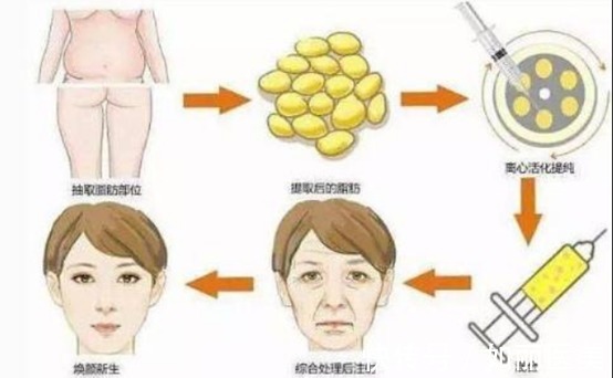 填充 自体脂肪填充面部安全吗,术后能维持多久呢?