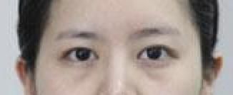 不用医美就可以解决？谁说眼袋不可逆～