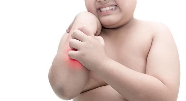 药物|婴儿得了湿疹就不能洗澡?错,关于它的5大谣言要认清,别再上当了