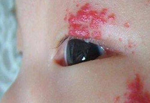 胎儿|孕妈吃酱油会让胎儿脸上长胎记?孕期做好这几项防护,让胎记远离