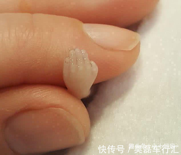 婴孩|女子流产后,将14周“孩子”放进冰箱并分享,照片中孩子仅10厘米