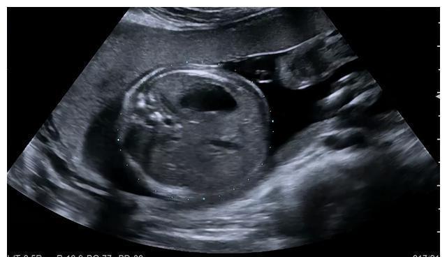 中孕期|中孕期的“大排畸”到底查什么?