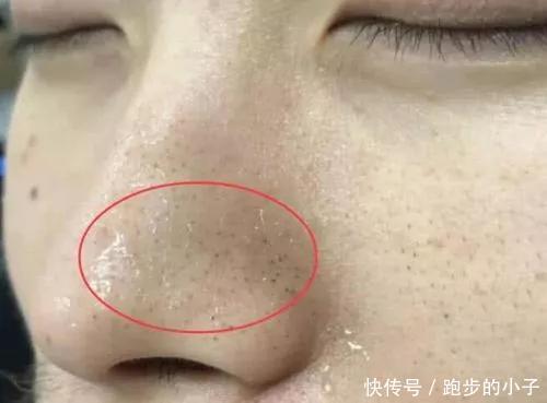 皮脂|黑头反反复复那是因为你用错了方法